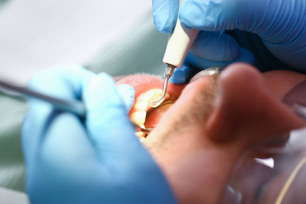 Best Emergency Dentist for Lost Fillings or Crowns in Loomis, CA